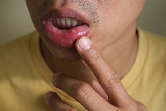 How To Help Soothe A Mouth Ulcer Book An Appointment 2043